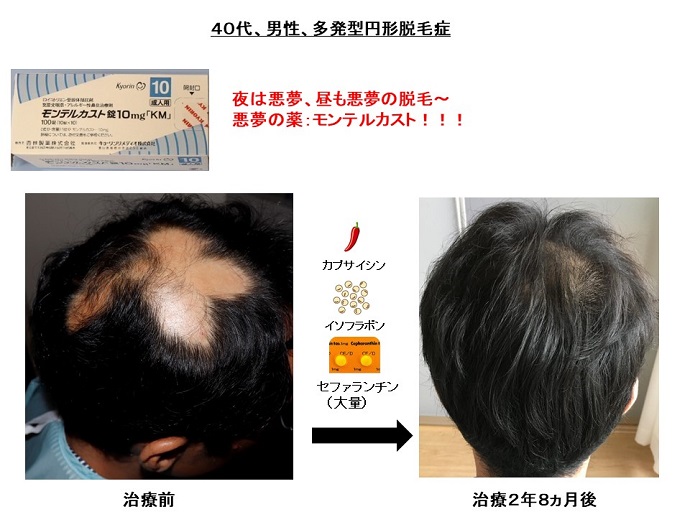 円形脱毛症　病院